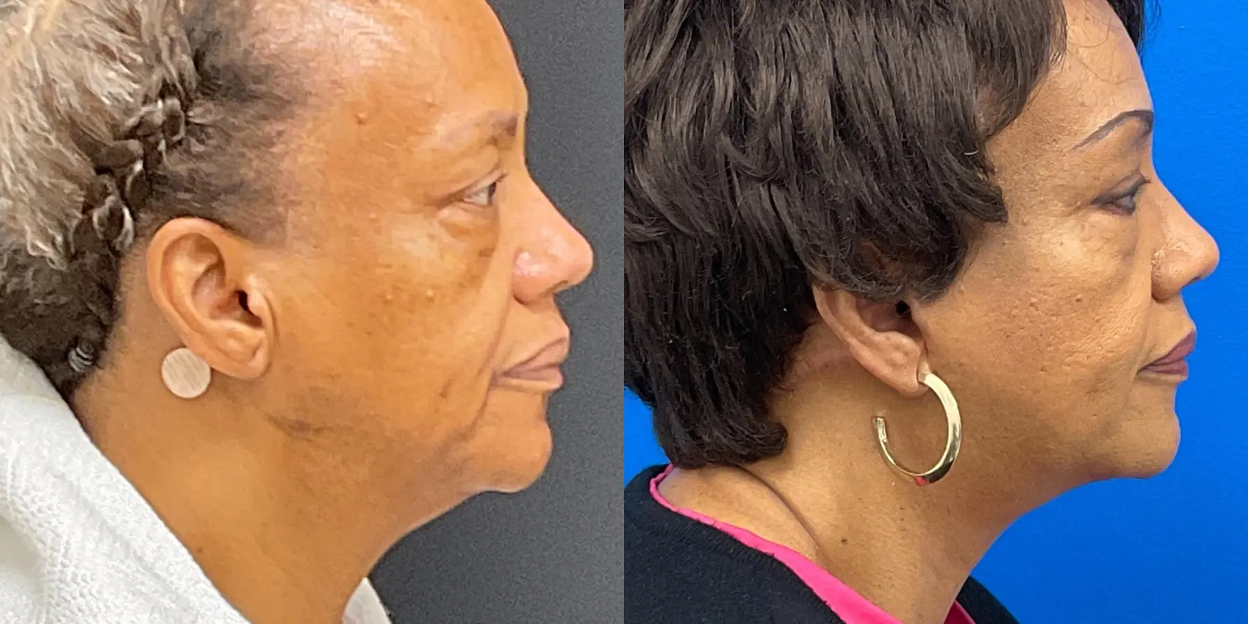 Facelift: Patient 1 - Before and After 1