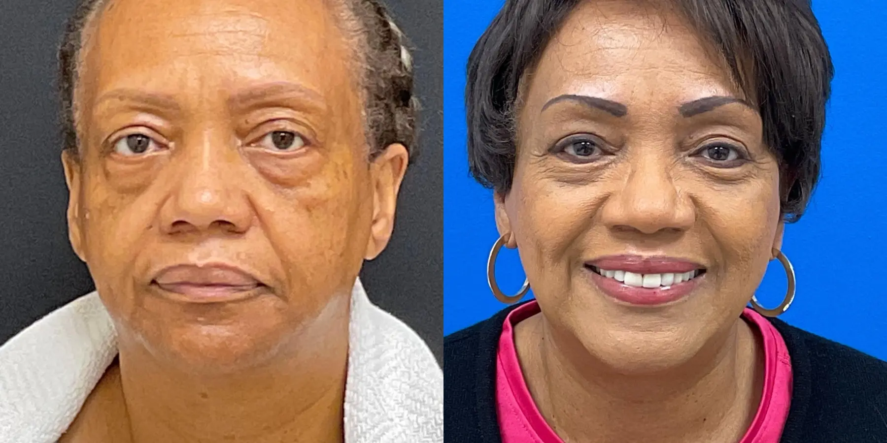 Facelift: Patient 1 - Before and After 5