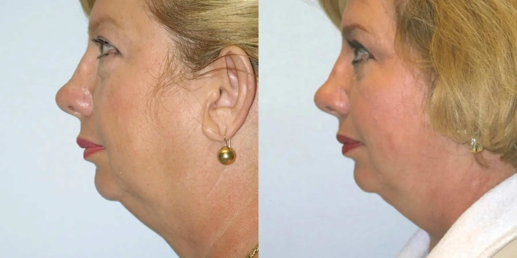 Facelift: Patient 8 - Before and After 3