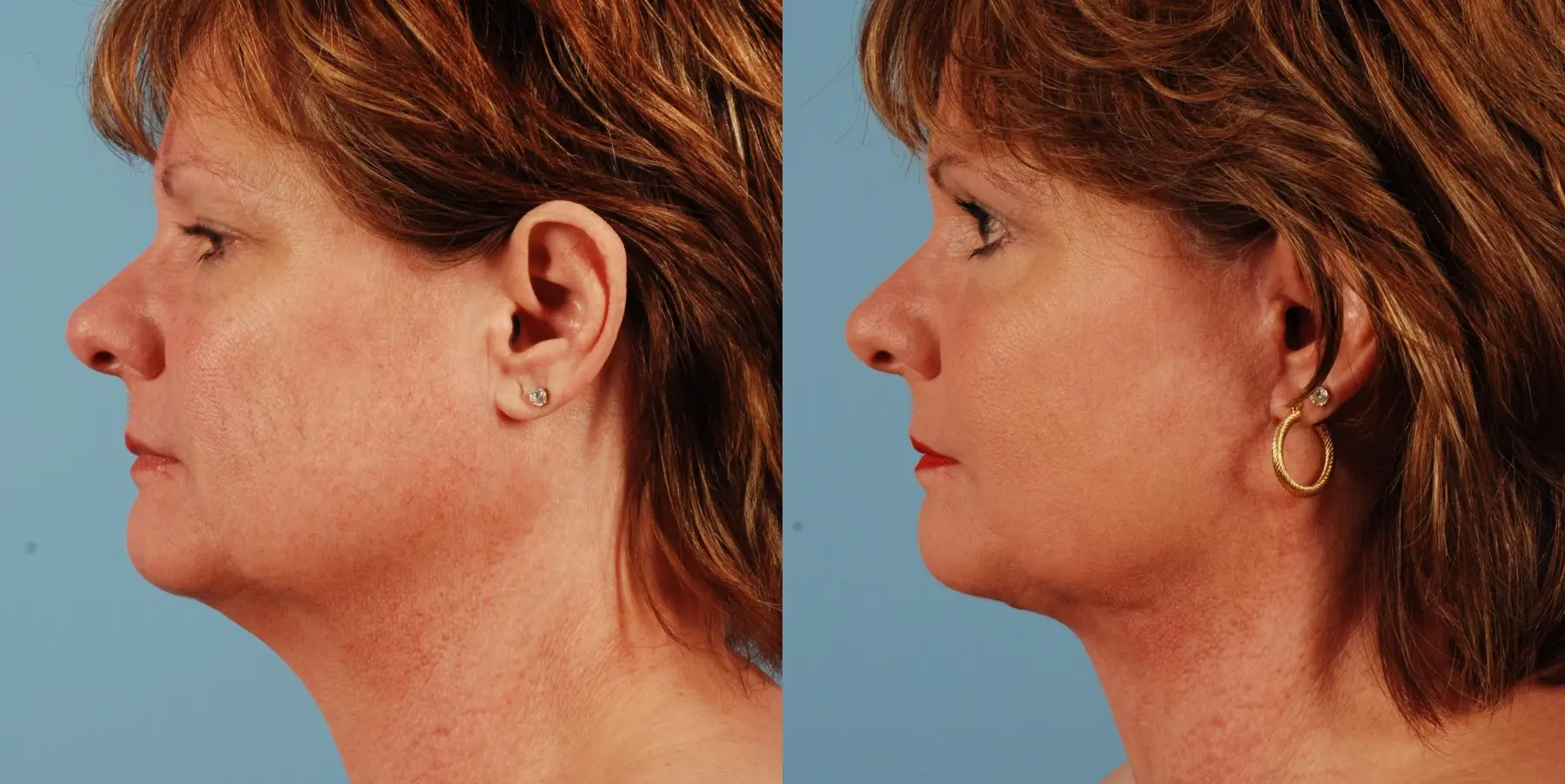 Facelift: Patient 9 - Before and After 3