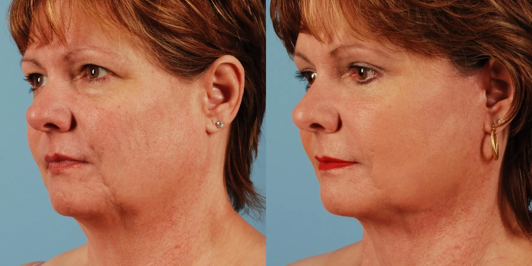 Facelift: Patient 3 - Before and After 2