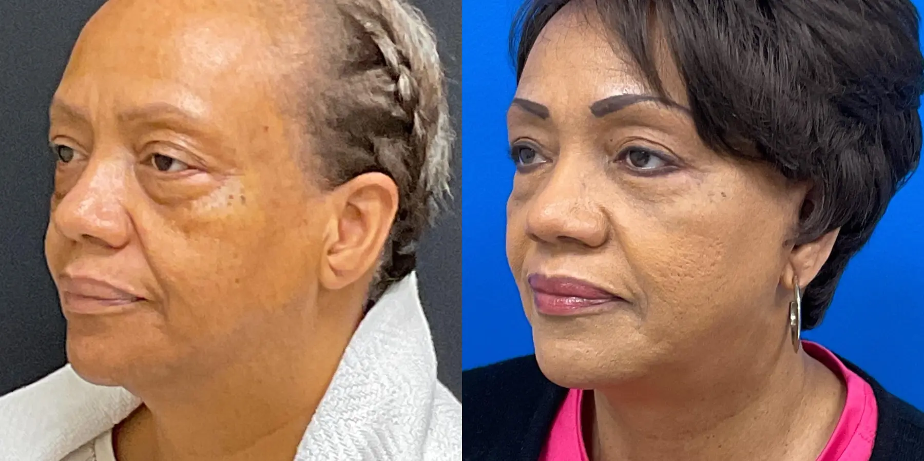 Facelift: Patient 1 - Before and After 2