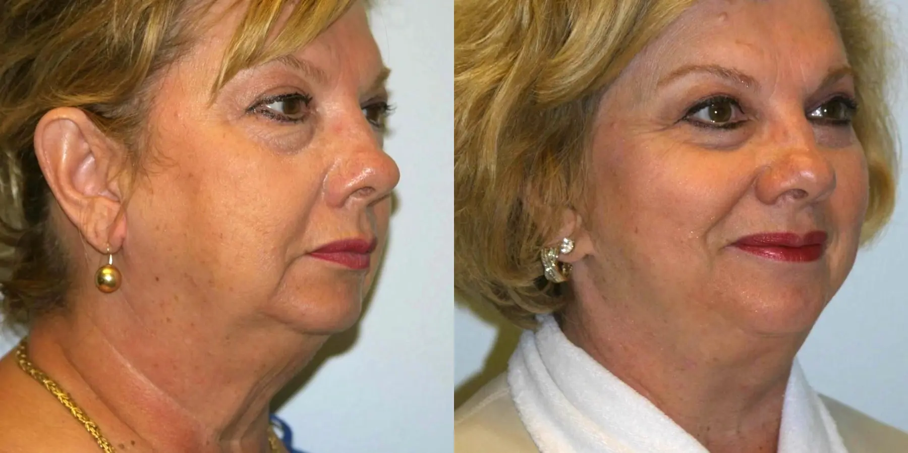 Facelift: Patient 8 - Before and After  