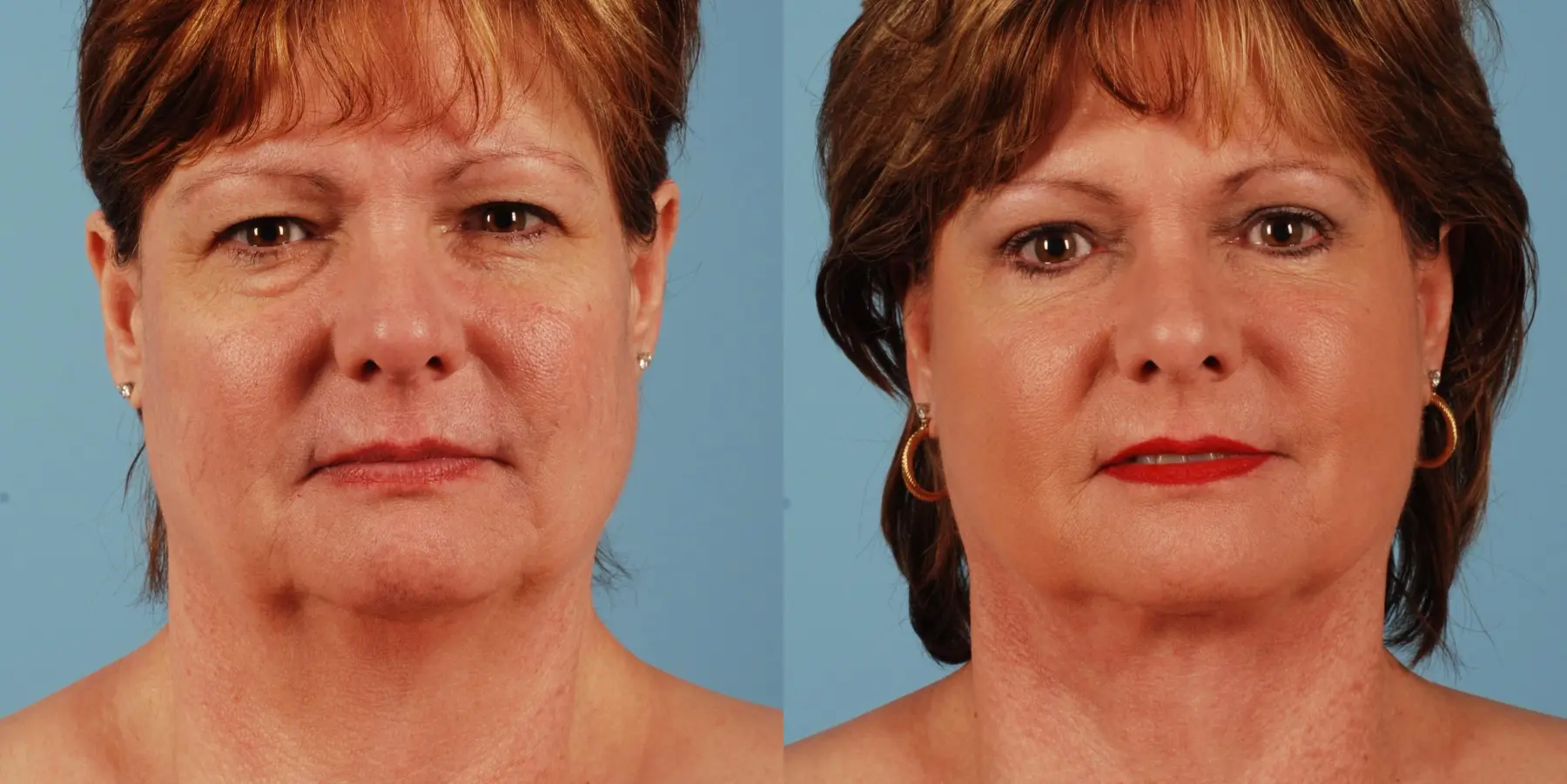 Facelift: Patient 9 - Before and After  