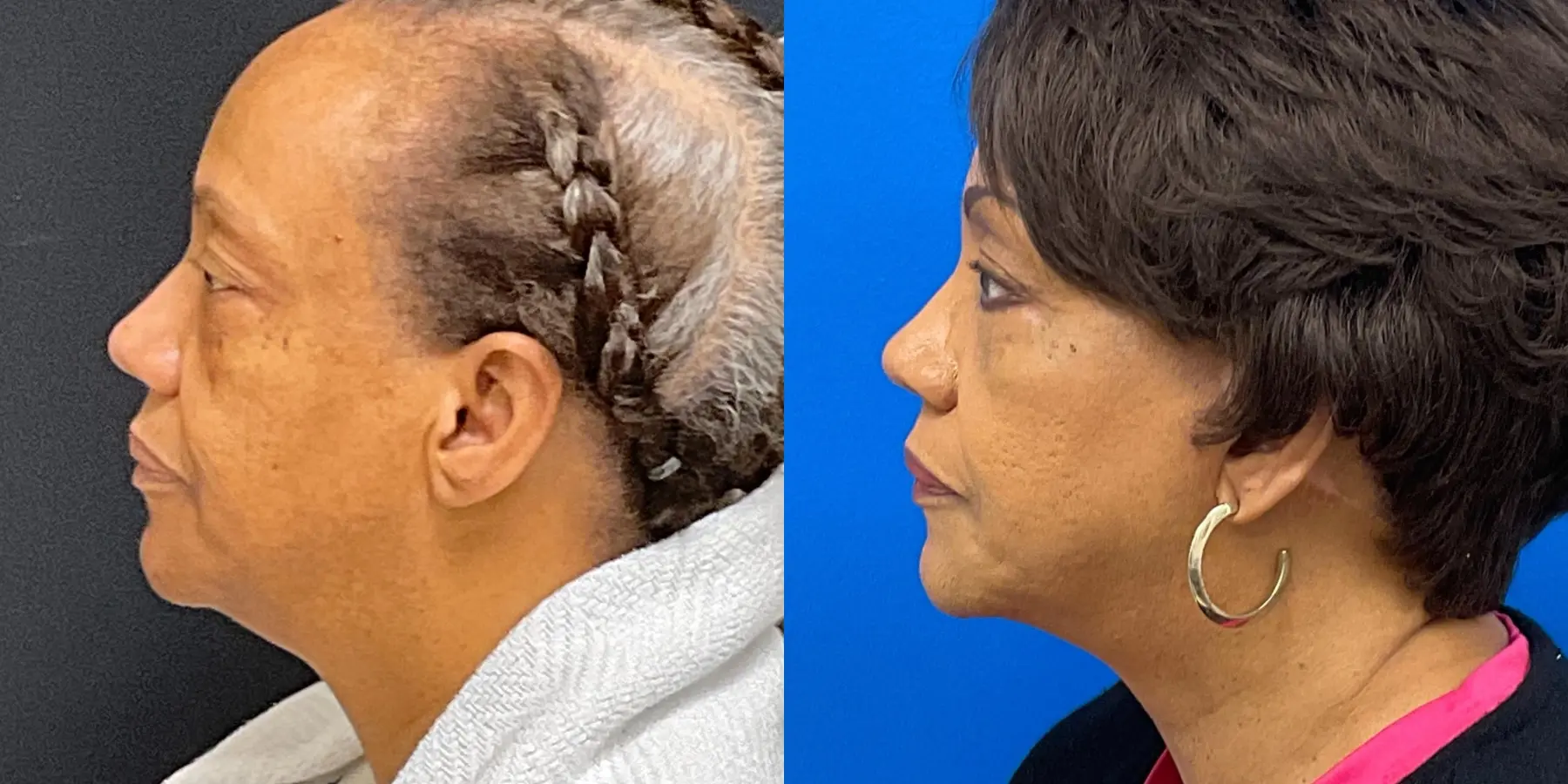 Facelift: Patient 1 - Before and After 4