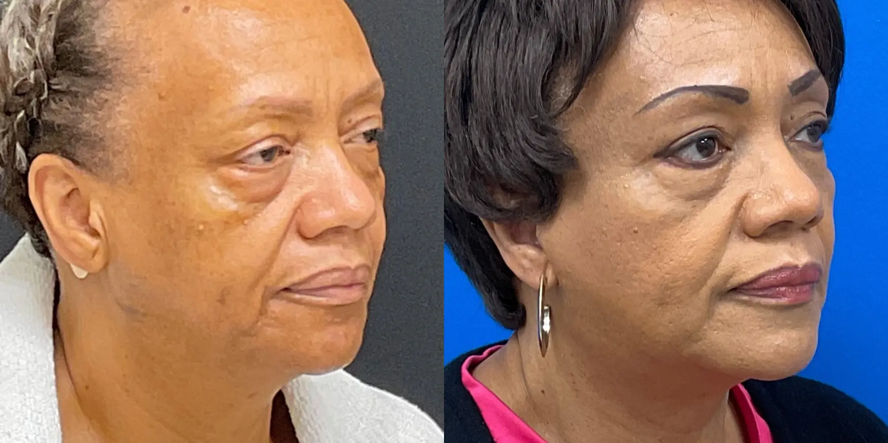 Facelift: Patient 1 - Before and After 3