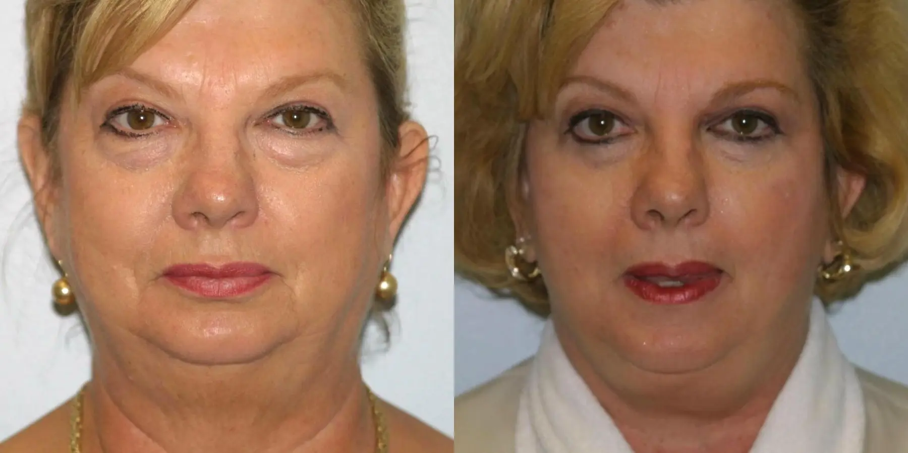 Facelift: Patient 2 - Before and After 2