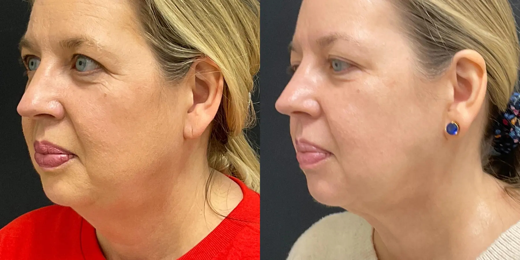 FaceTite: Patient 2 - Before and After 4