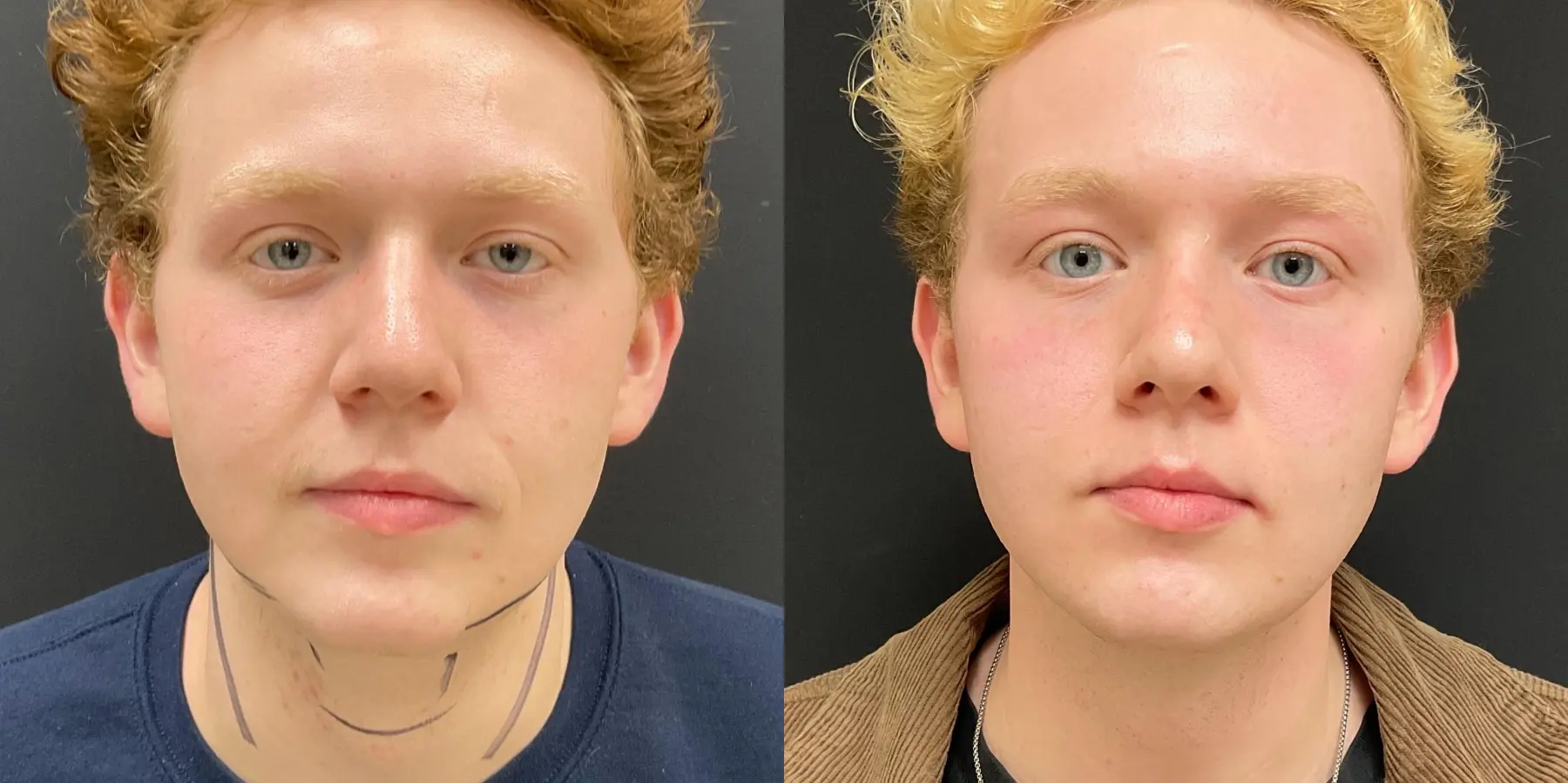 Facetite For Men: Patient 1 - Before and After 3