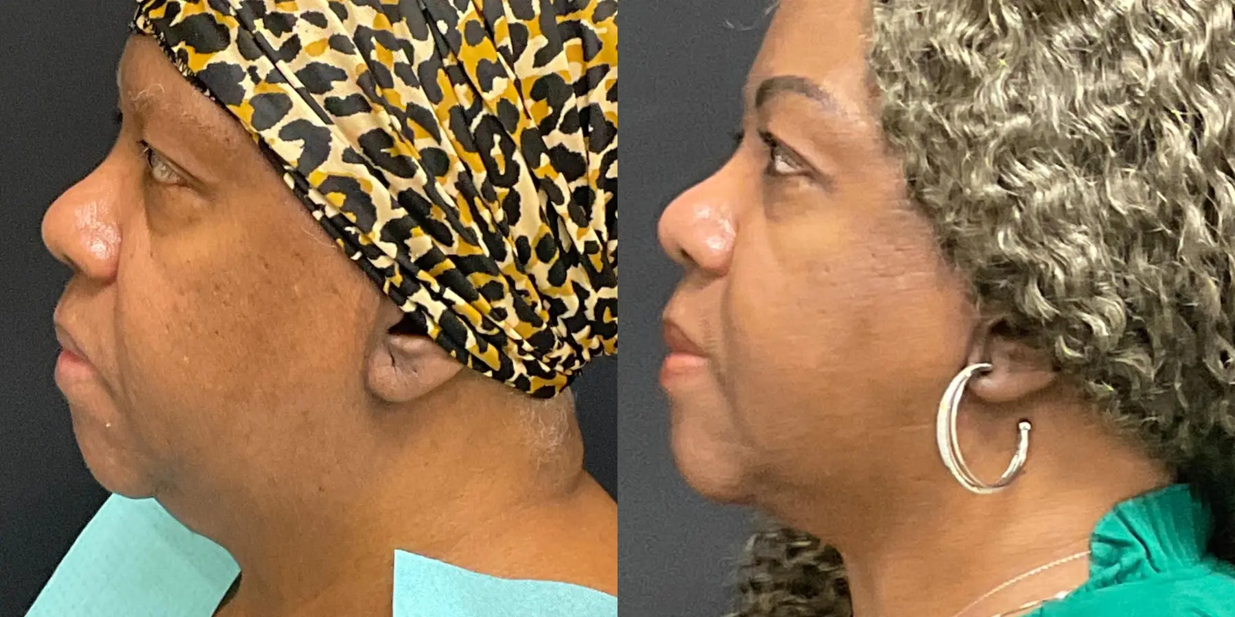 FaceTite: Patient 3 - Before and After 5