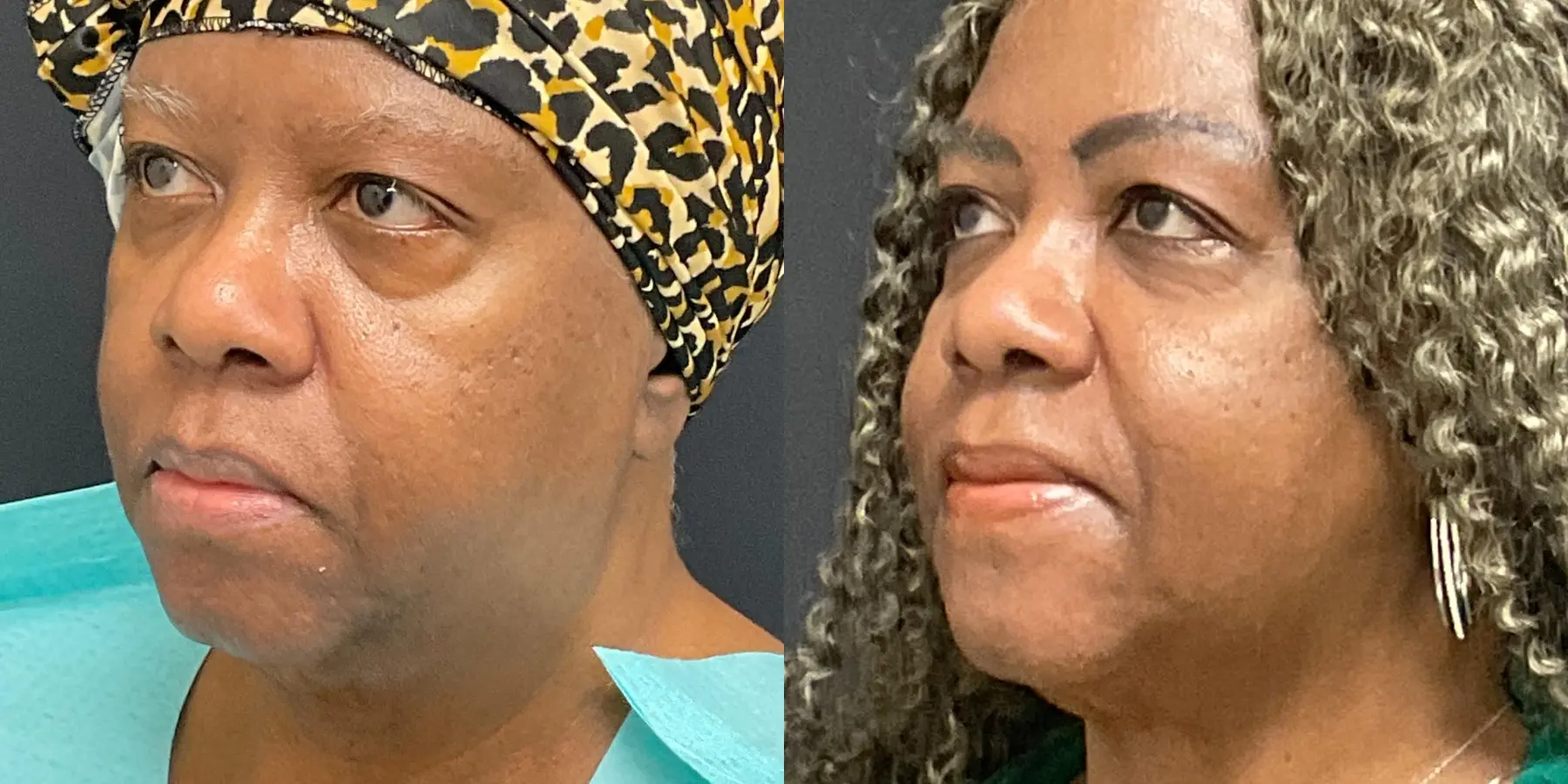 FaceTite: Patient 3 - Before and After 4