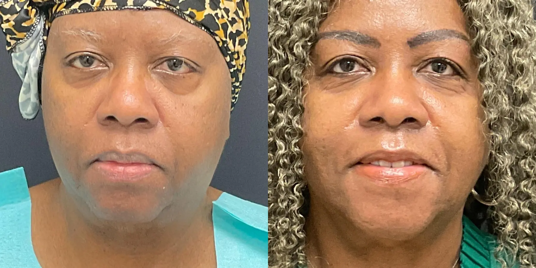 FaceTite: Patient 3 - Before and After 3