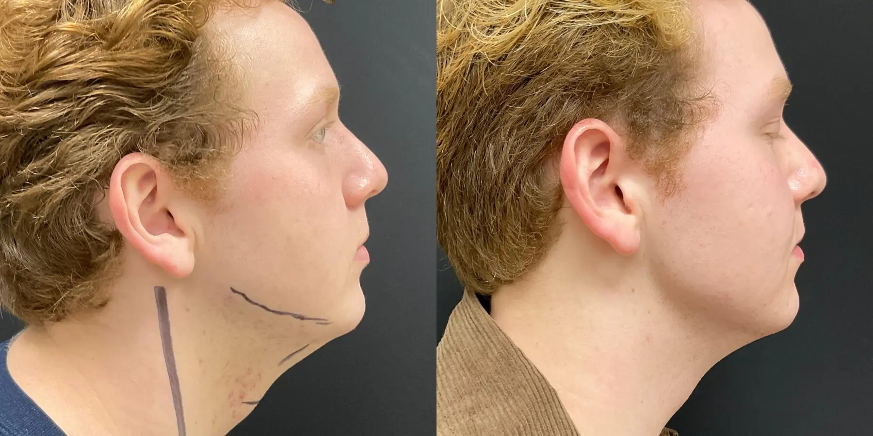 Facetite For Men: Patient 1 - Before and After 1