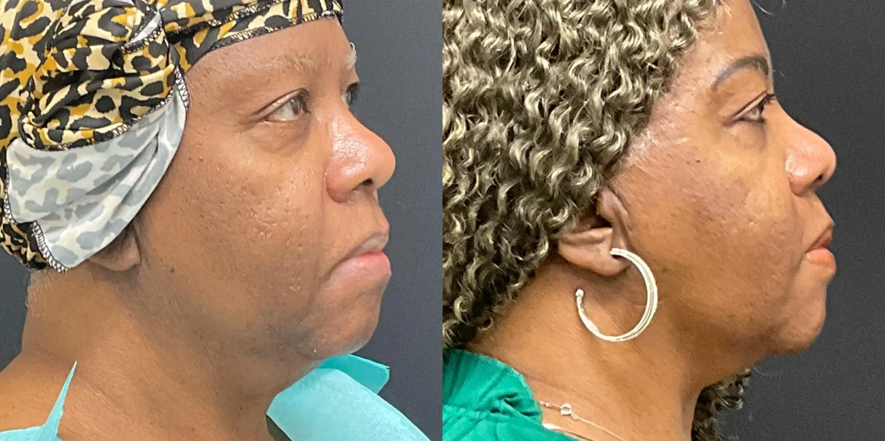 FaceTite: Patient 3 - Before and After 1