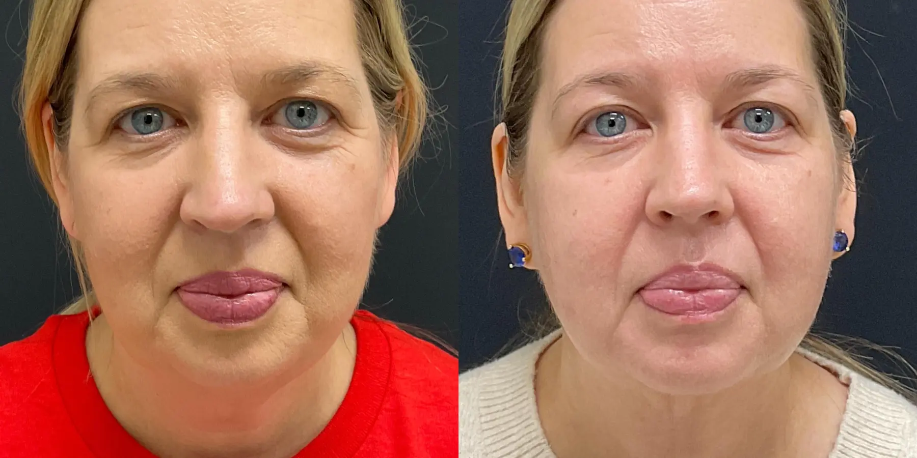 FaceTite: Patient 2 - Before and After 3