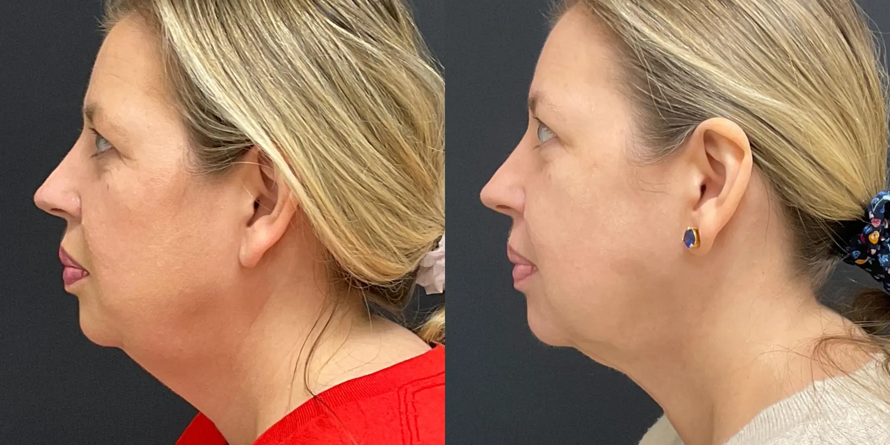 FaceTite: Patient 2 - Before and After 5