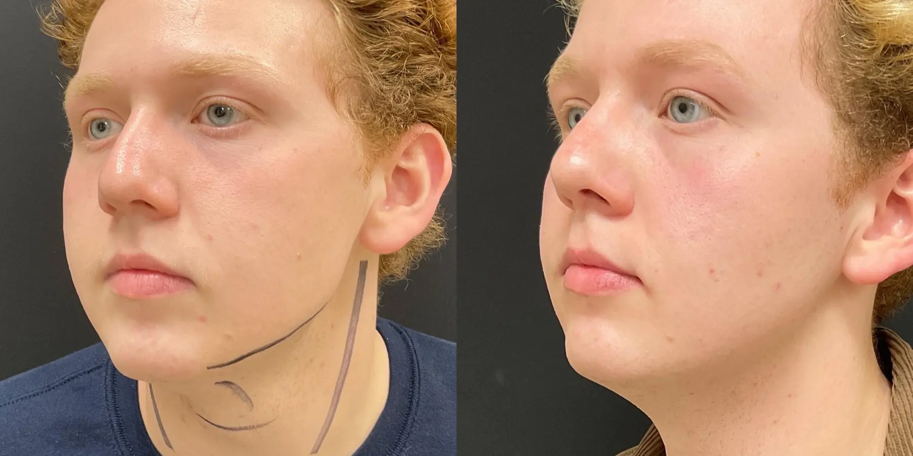 Facetite For Men: Patient 1 - Before and After 4