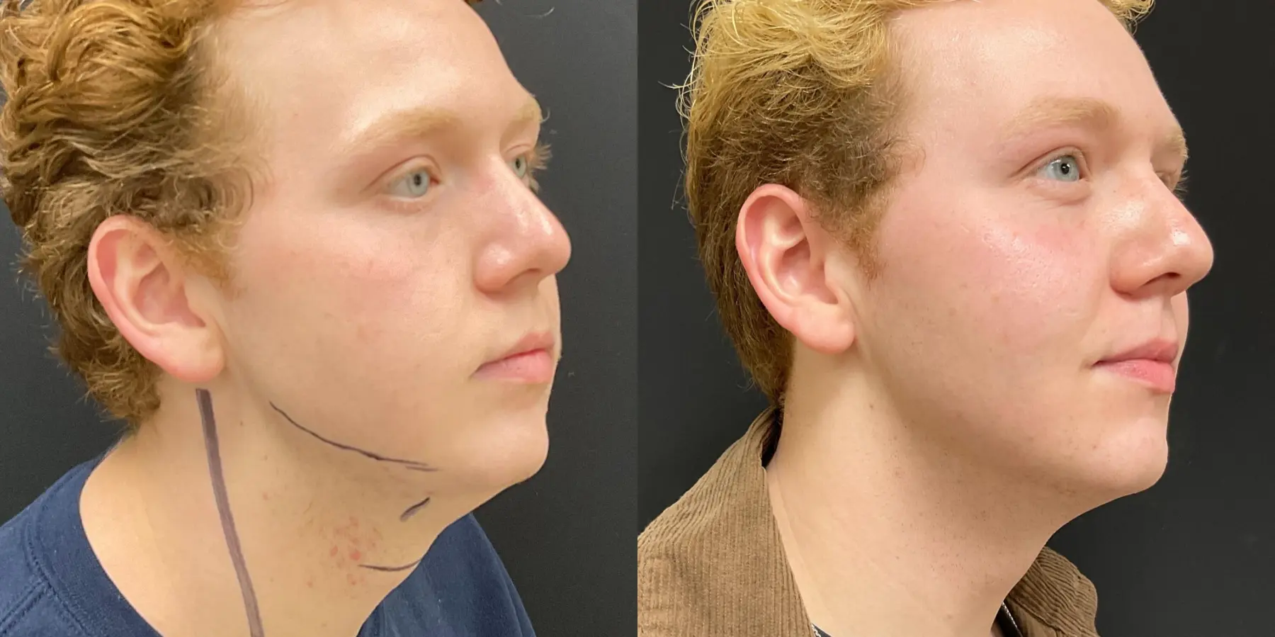 Facetite For Men: Patient 1 - Before and After 2