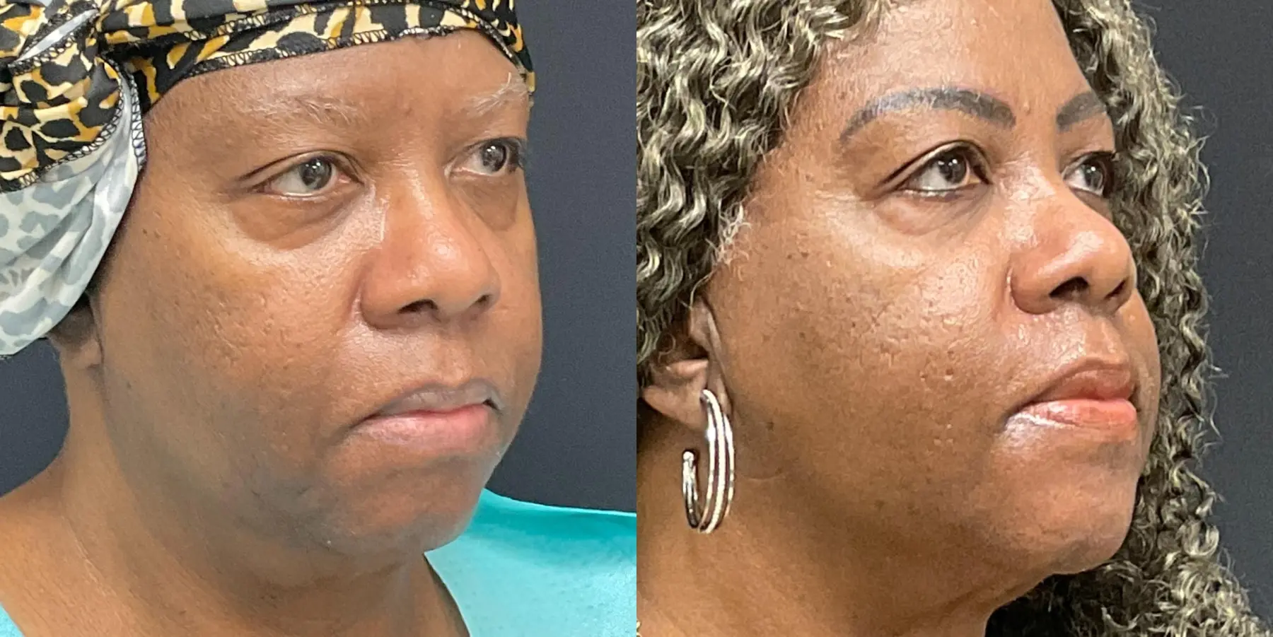 FaceTite: Patient 3 - Before and After 2