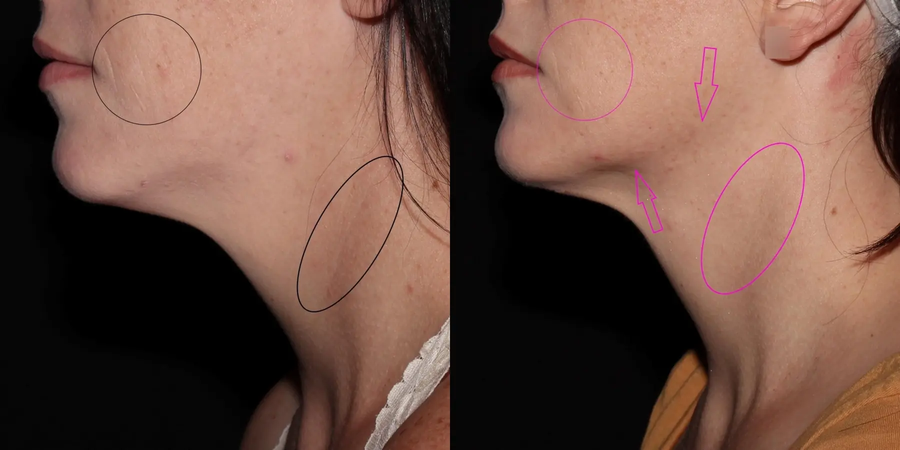 Fractional Resurfacing: Patient 1 - Before and After 2