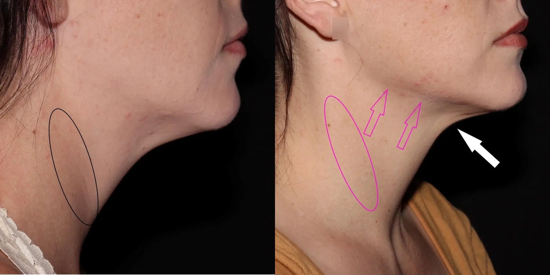 Fractional Resurfacing: Patient 1 - Before and After 3