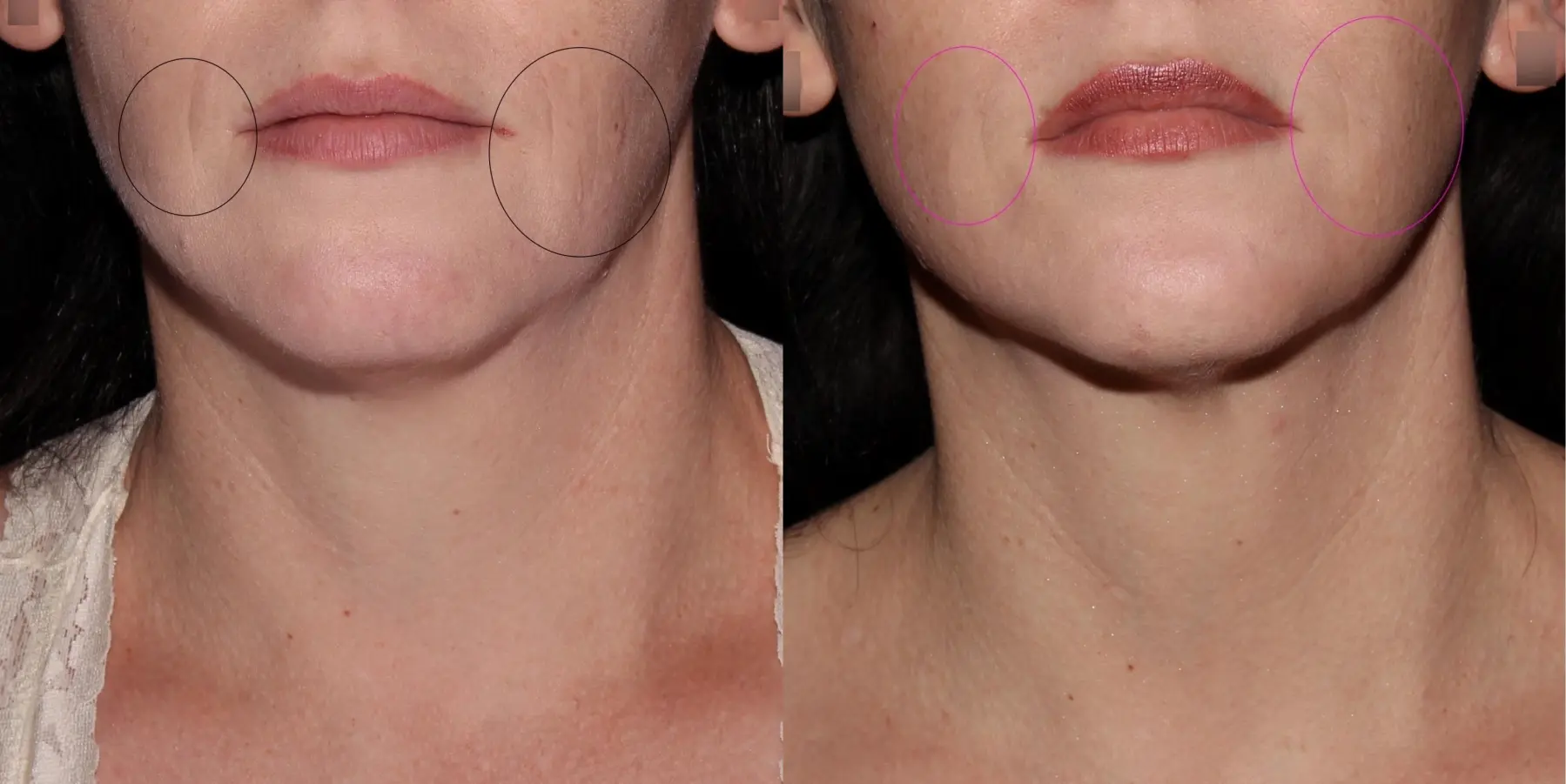 Fractional Resurfacing: Patient 1 - Before and After  