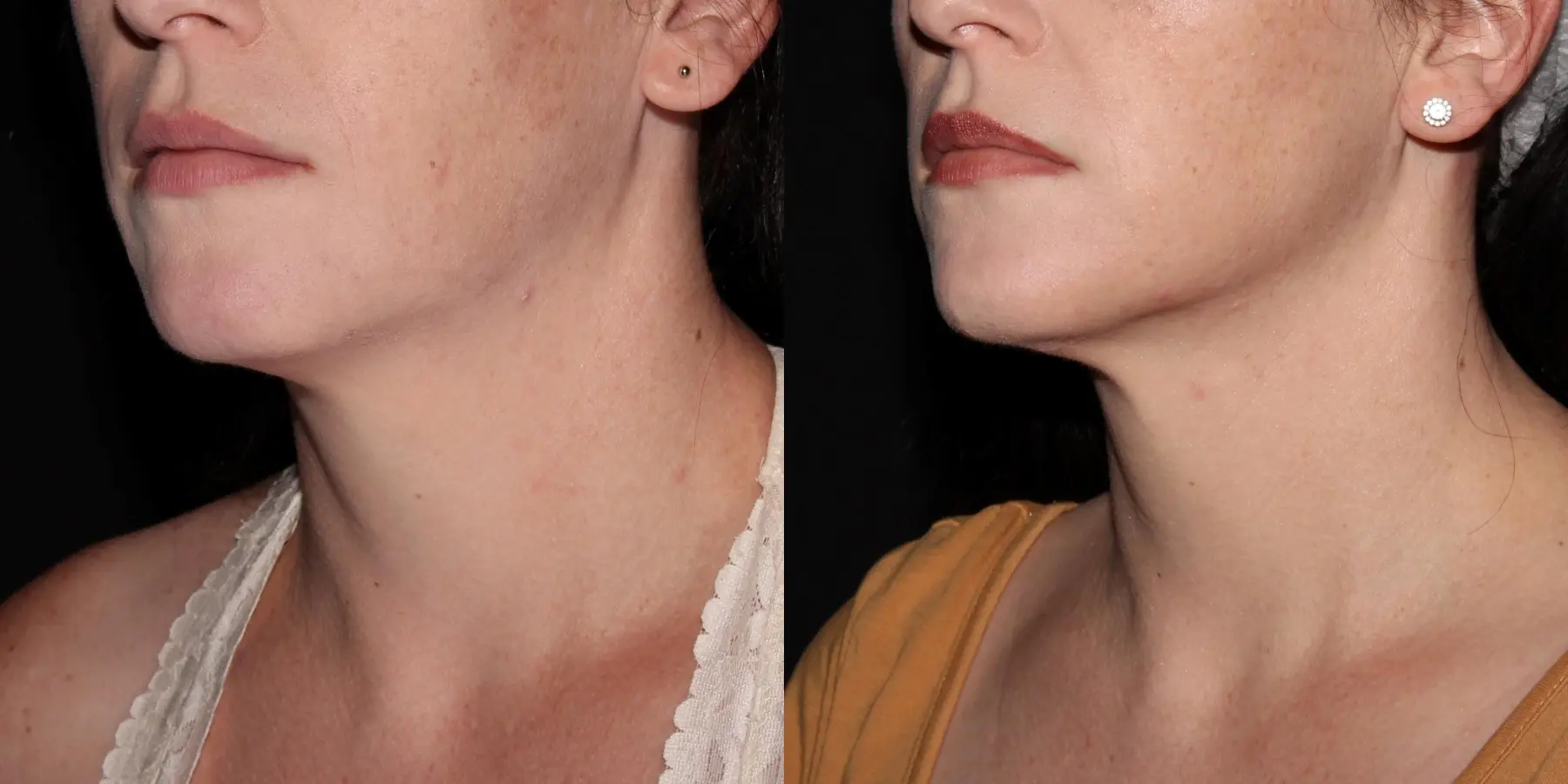 Fractional Resurfacing: Patient 1 - Before and After 4