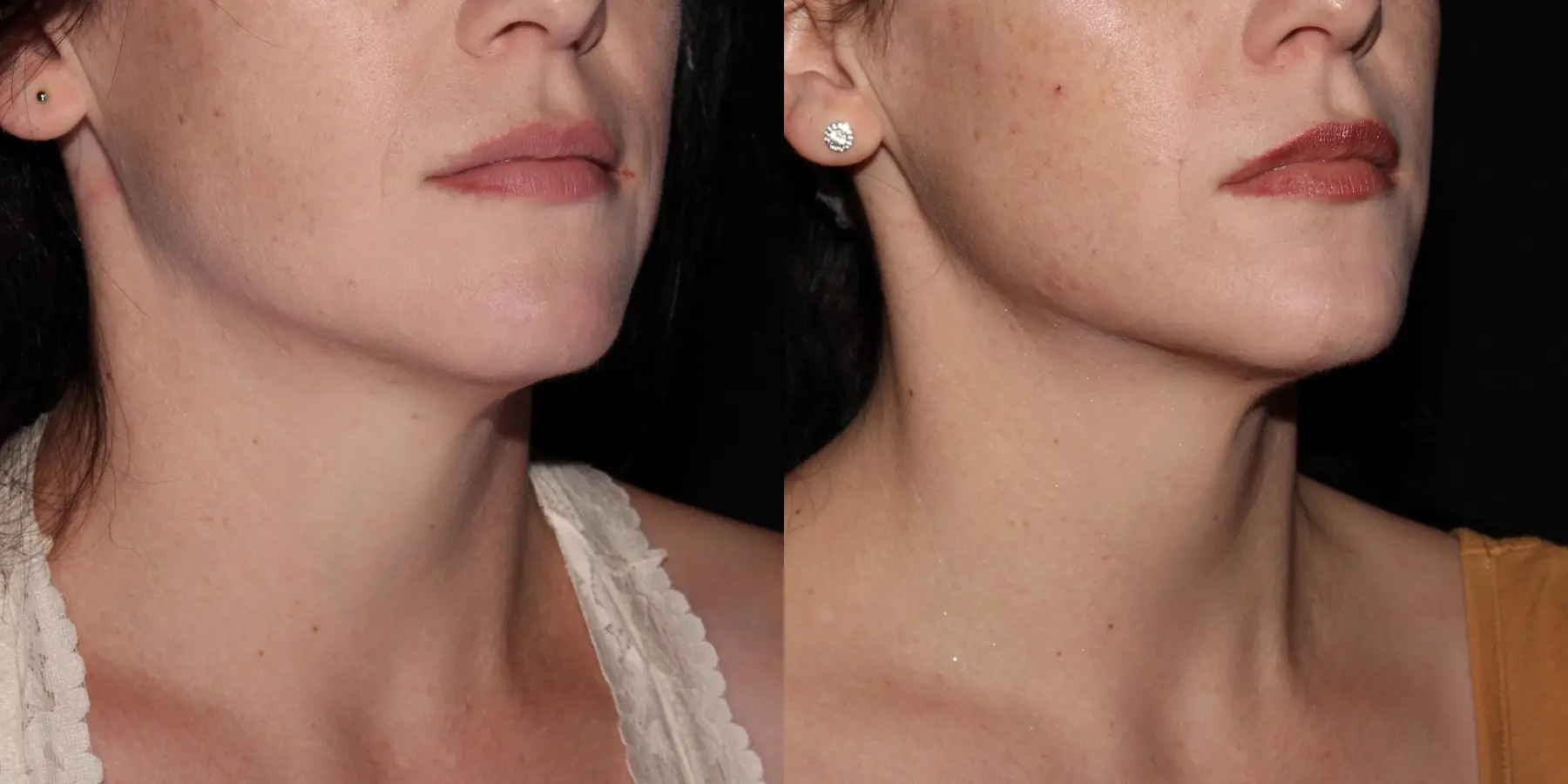 Fractional Resurfacing: Patient 1 - Before and After 5