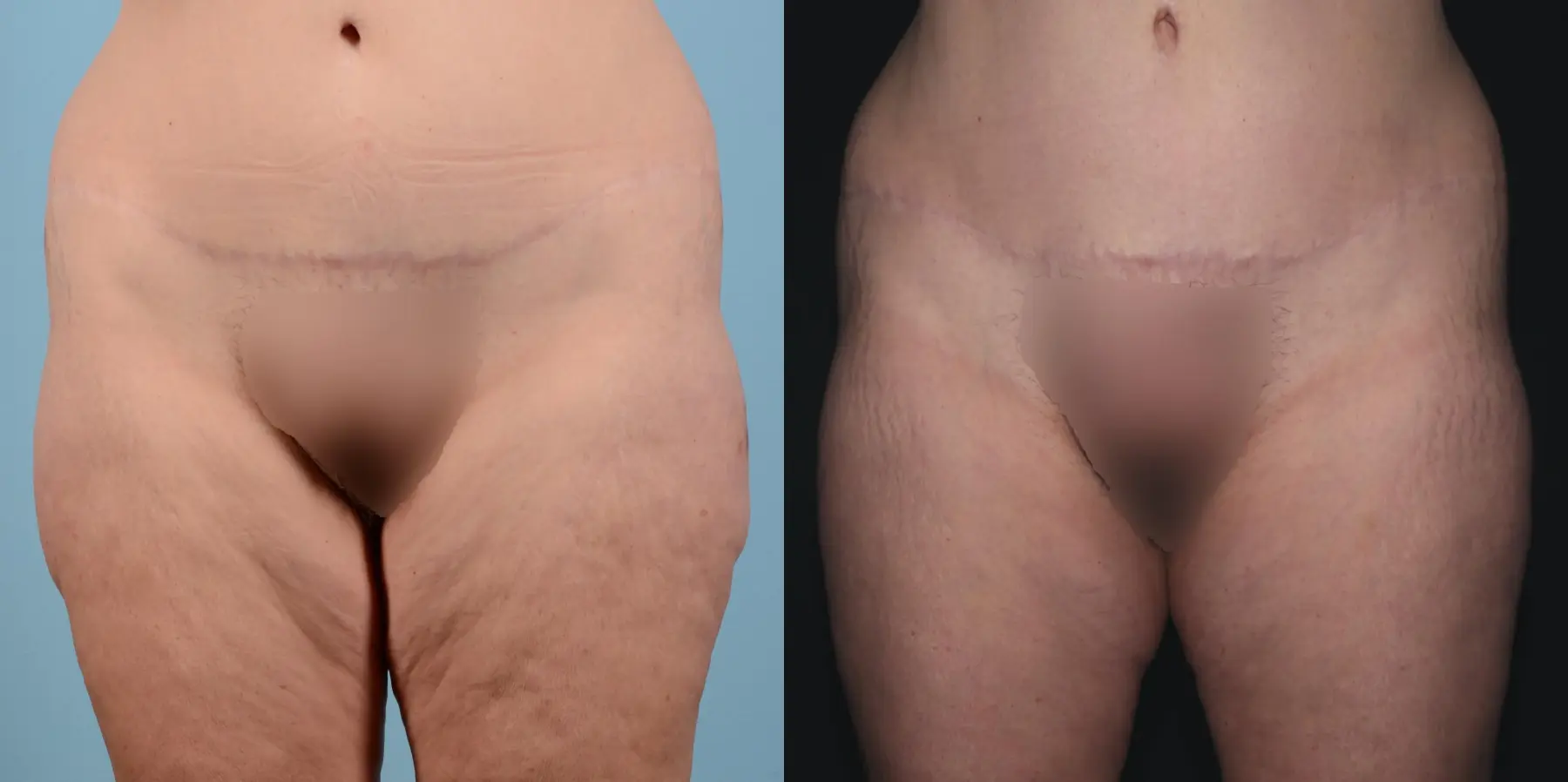 Liposuction: Patient 15 - Before and After  