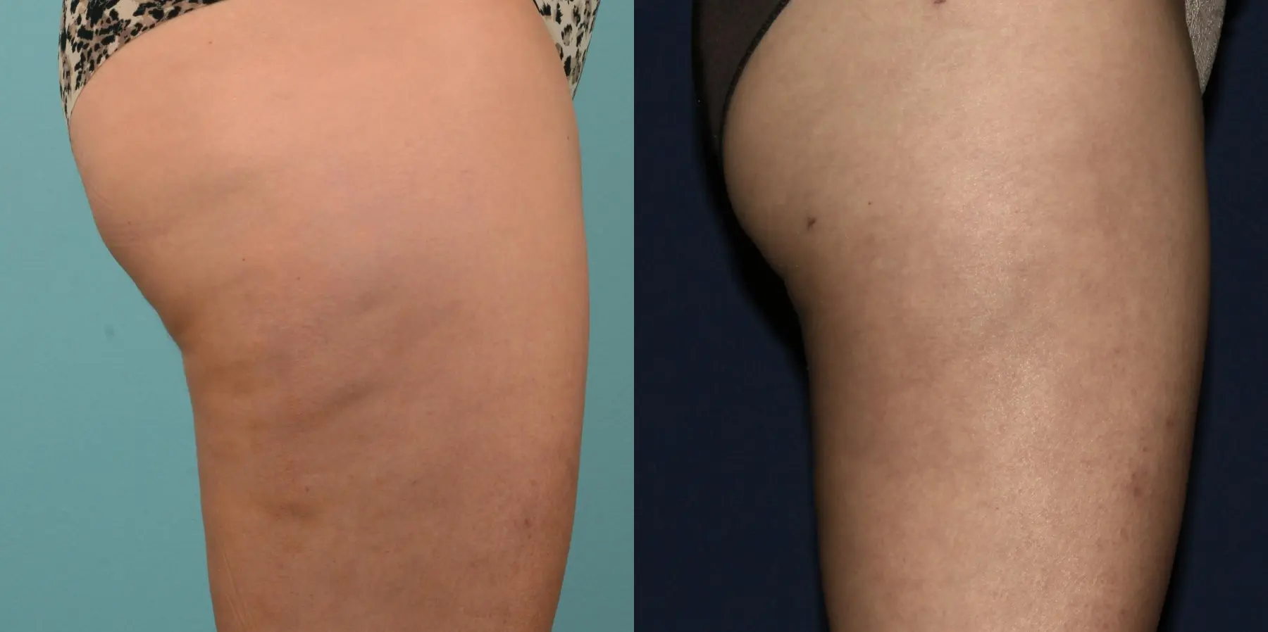 Liposuction: Patient 1 - Before and After 5