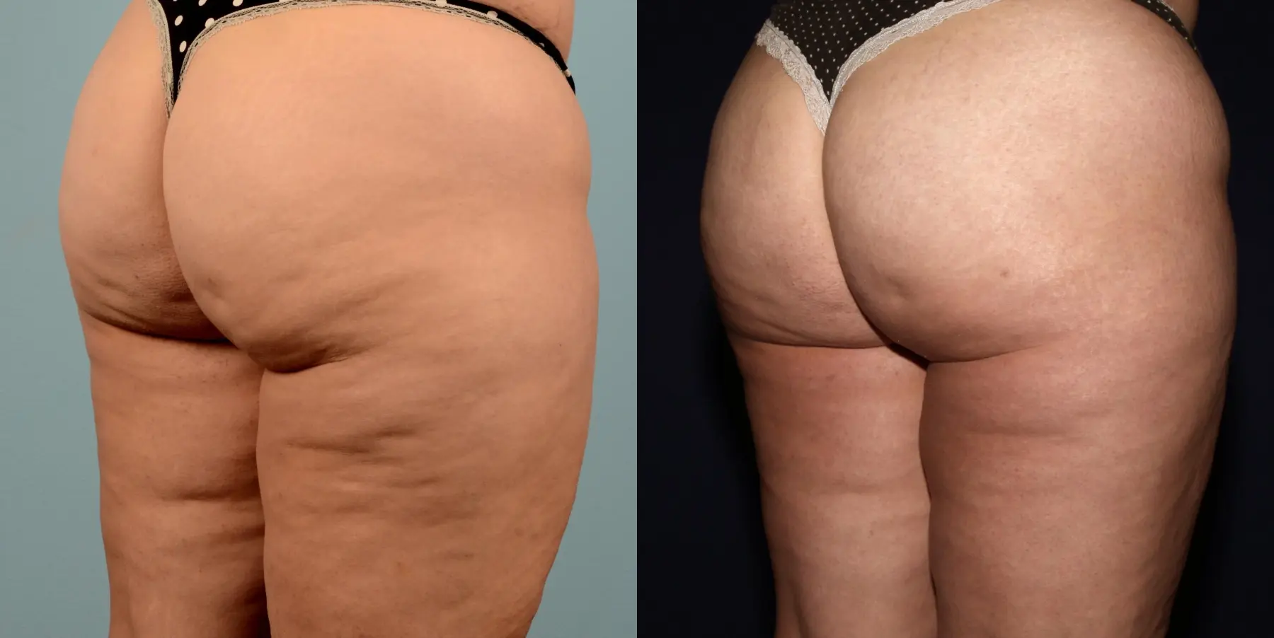 Liposuction: Patient 17 - Before and After 2