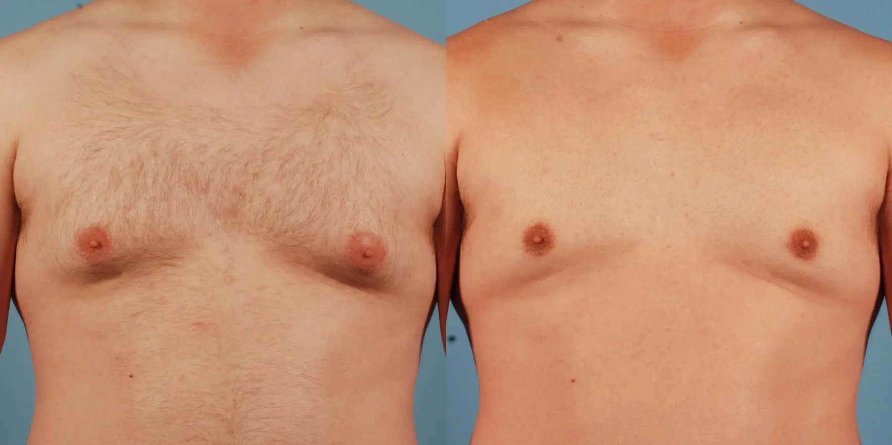 Liposuction-for-men: Patient 3 - Before and After  