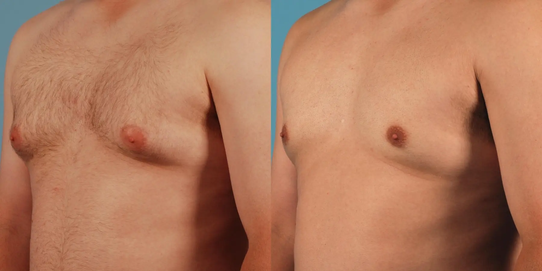 Liposuction For Men: Patient 3 - Before and After 2