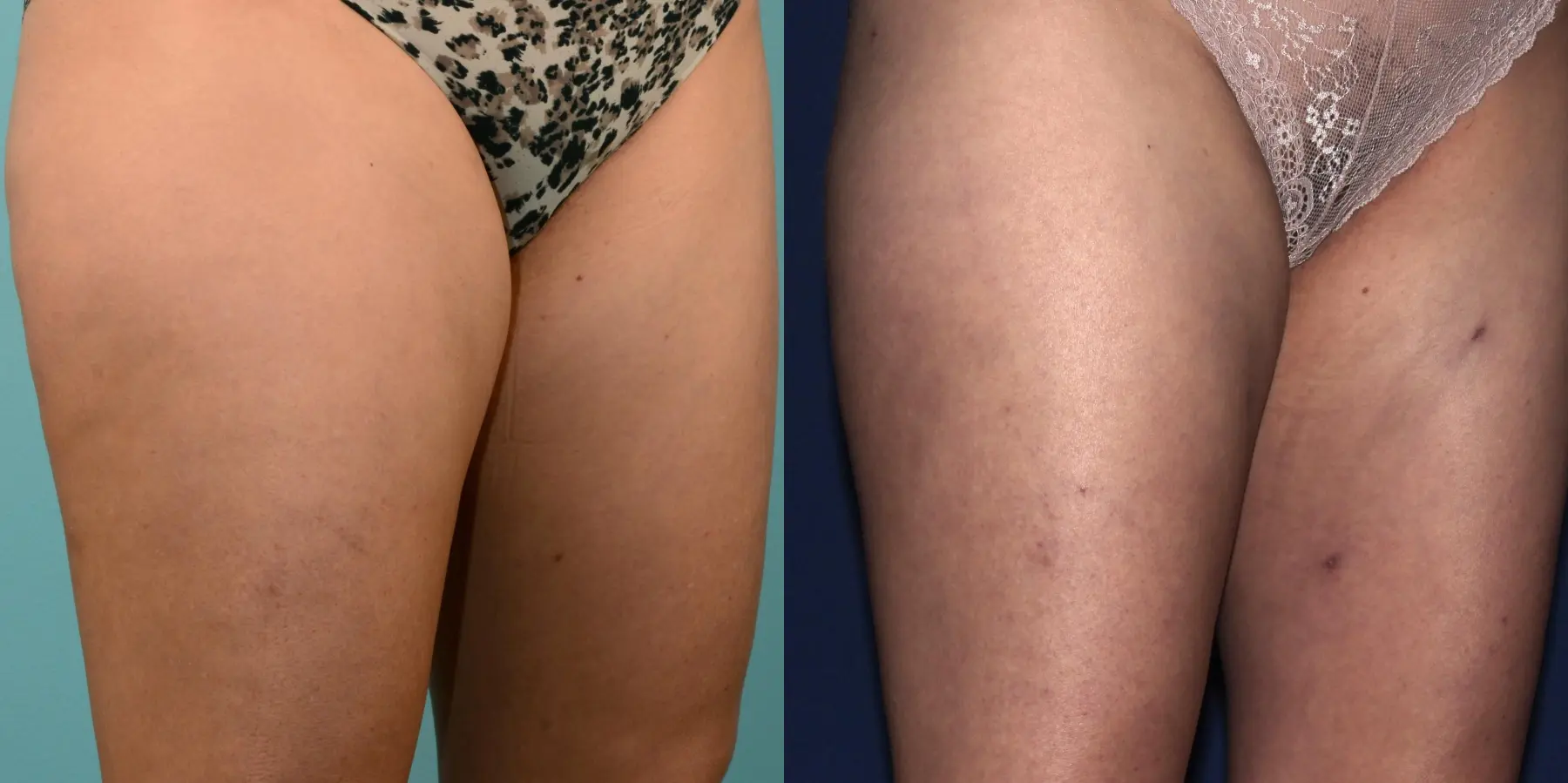 Liposuction: Patient 1 - Before and After 3