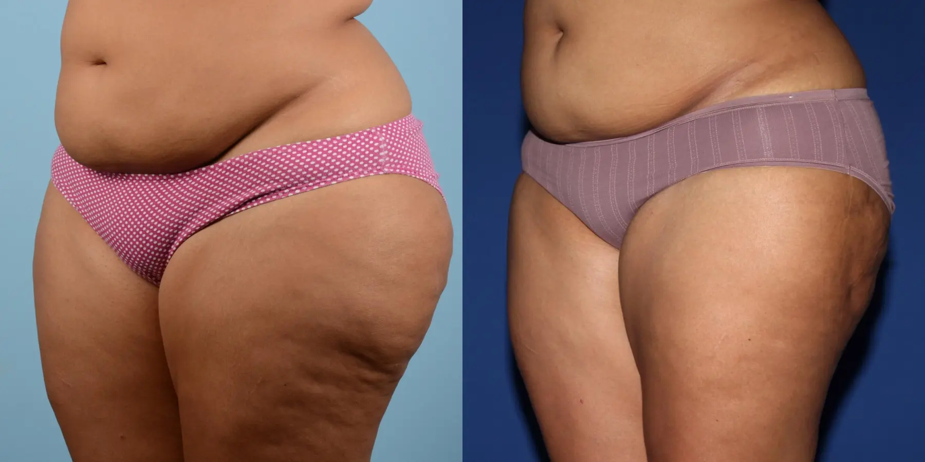 Liposuction: Patient 8 - Before and After 2