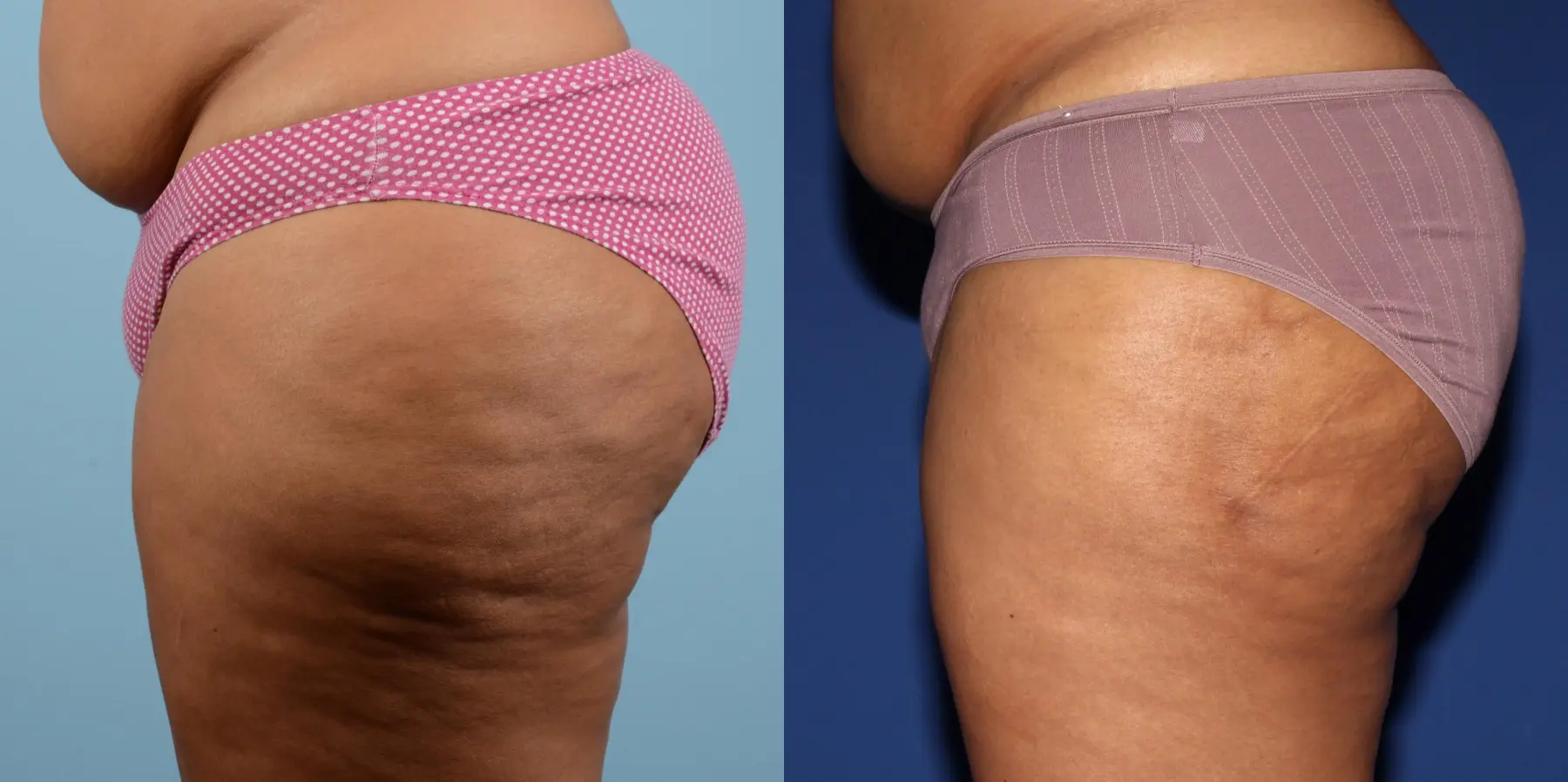 Liposuction: Patient 8 - Before and After 6