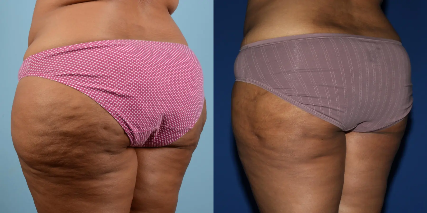 Liposuction: Patient 8 - Before and After 4