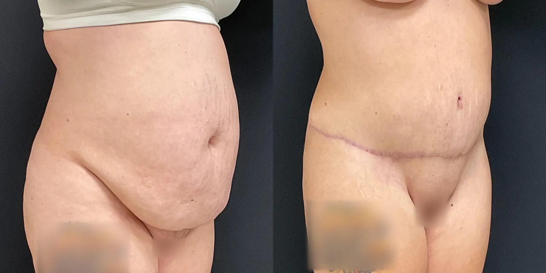 Liposuction: Patient 4 - Before and After 3