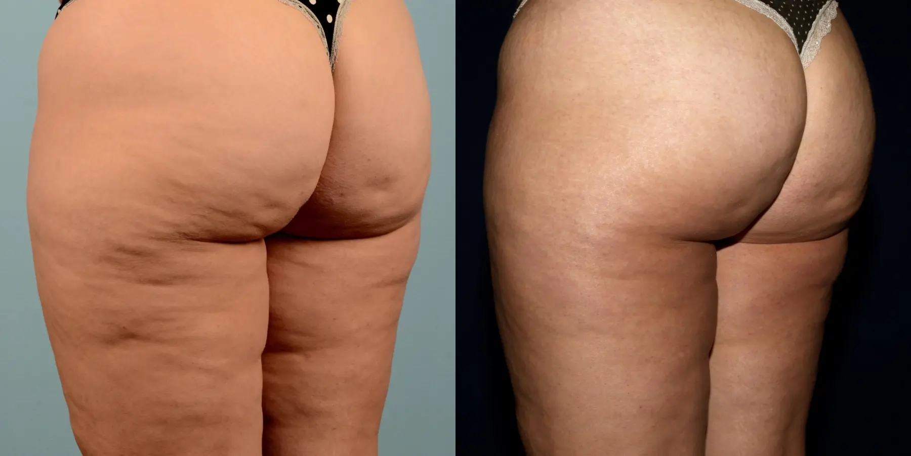 Liposuction: Patient 17 - Before and After 3