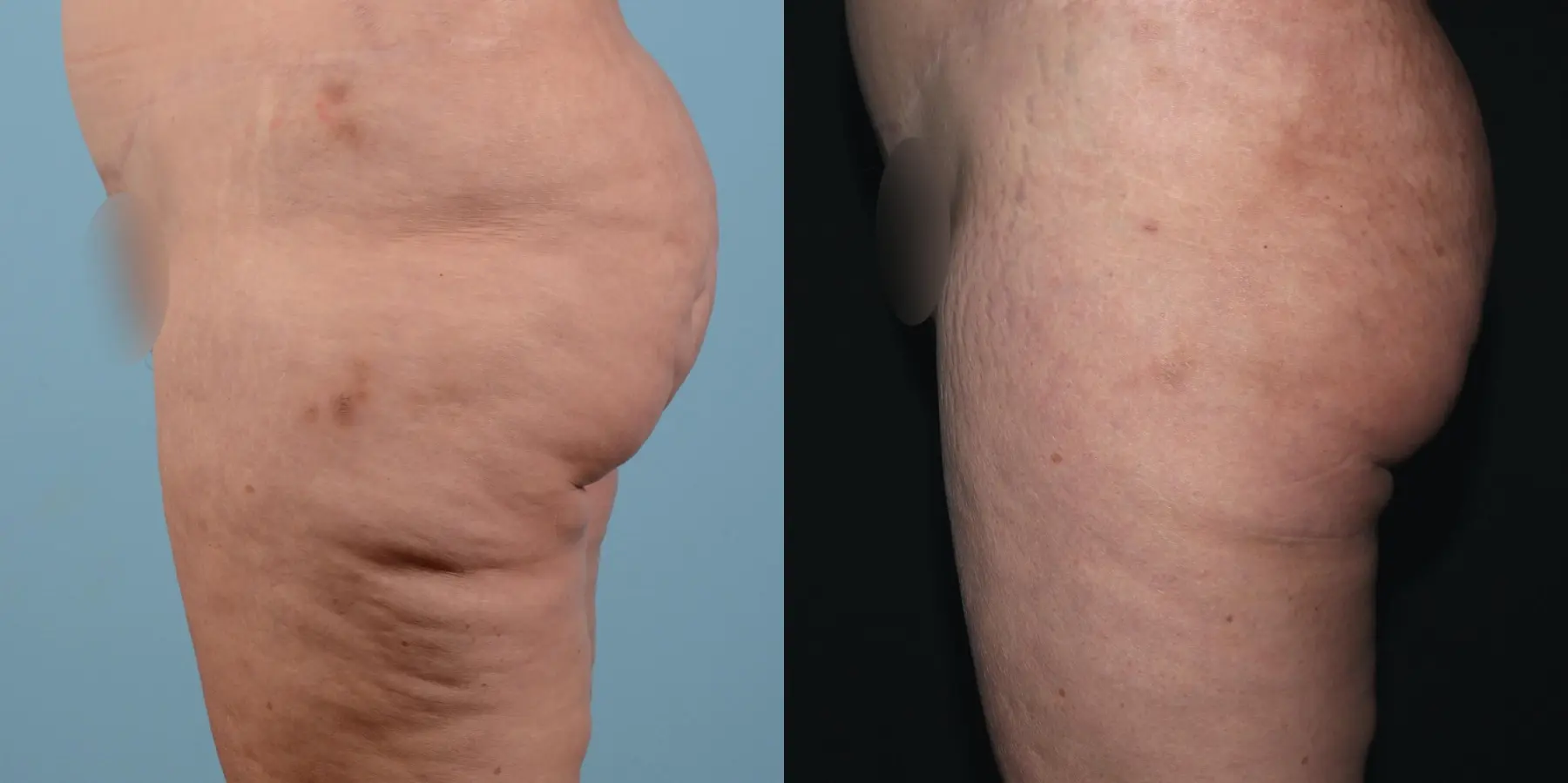 Liposuction: Patient 7 - Before and After 3