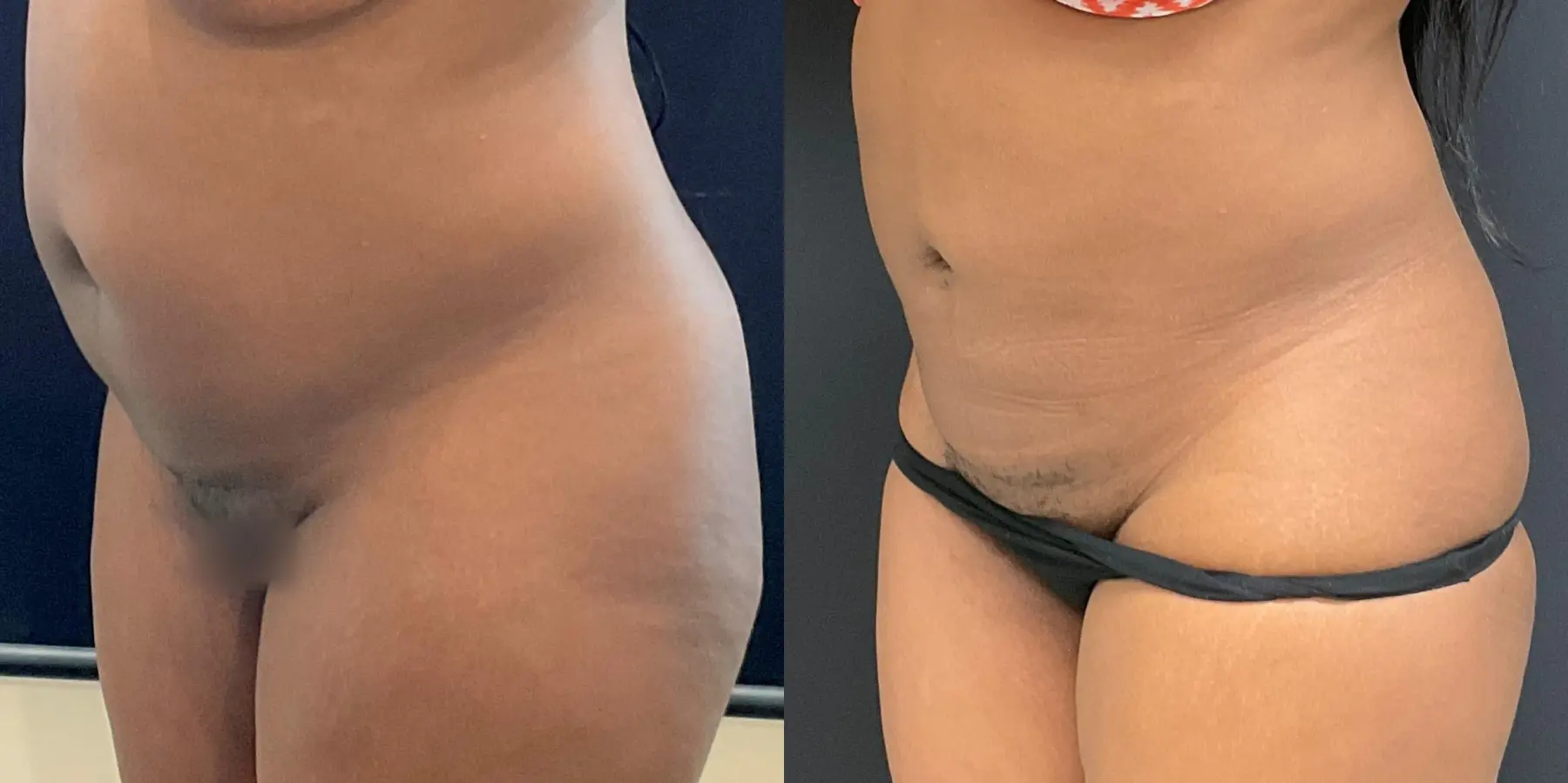 Liposuction: Patient 5 - Before and After 2