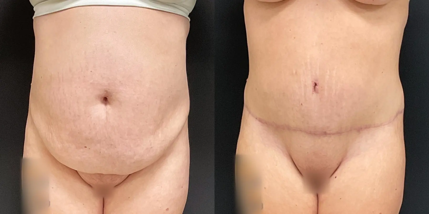 Liposuction: Patient 4 - Before and After  