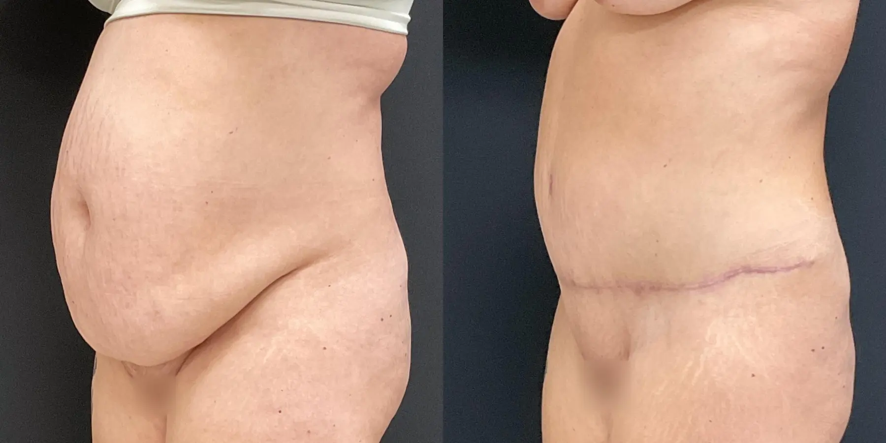 Liposuction: Patient 4 - Before and After 2