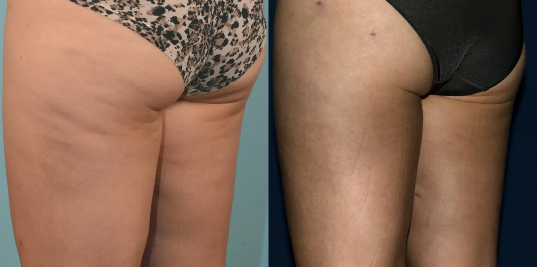 Liposuction: Patient 1 - Before and After 7