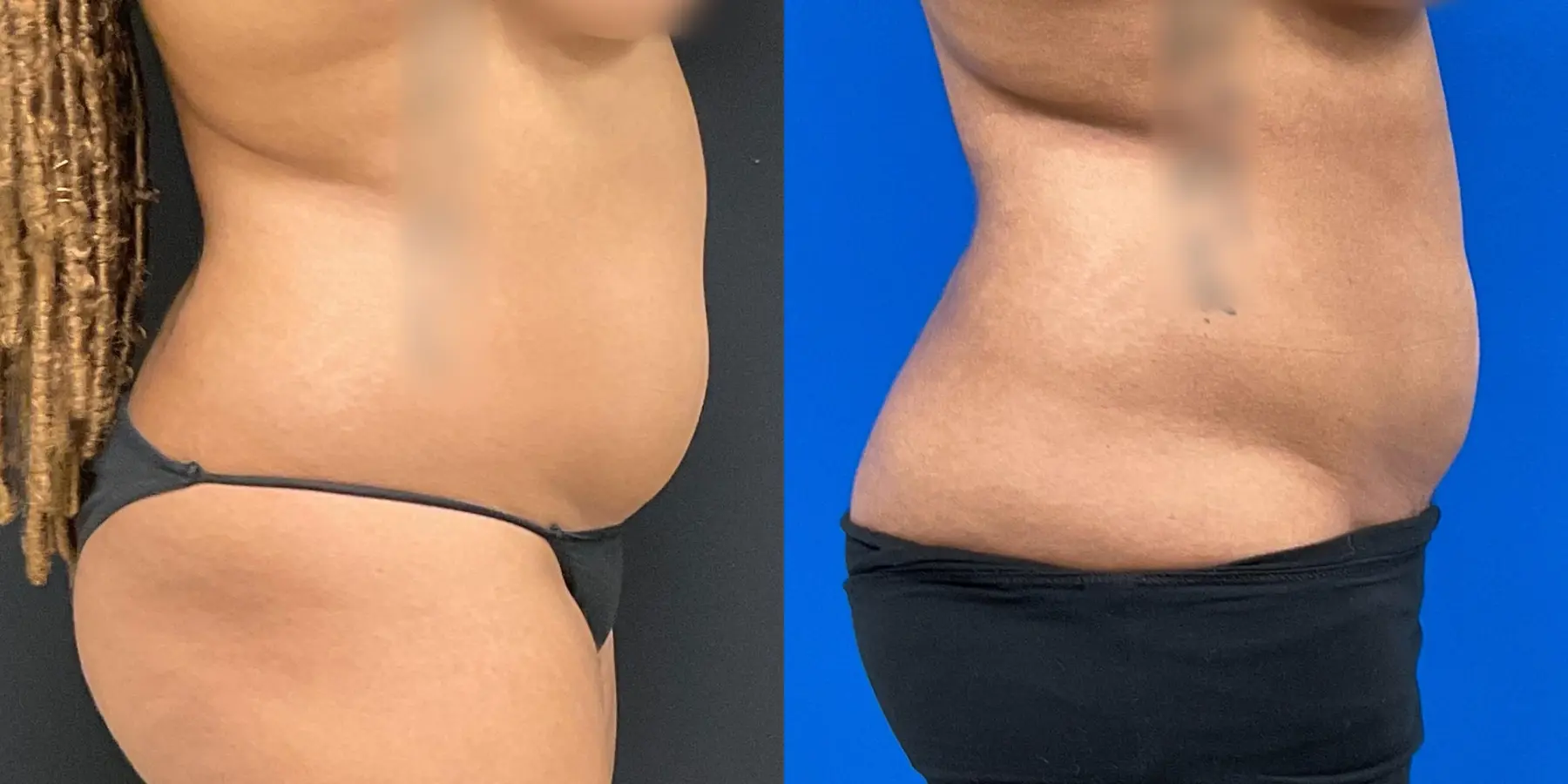 Liposuction: Patient 2 - Before and After 5