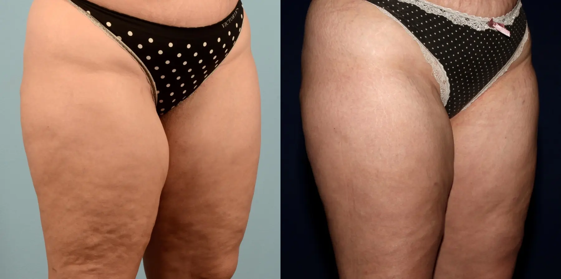 Liposuction: Patient 17 - Before and After 6