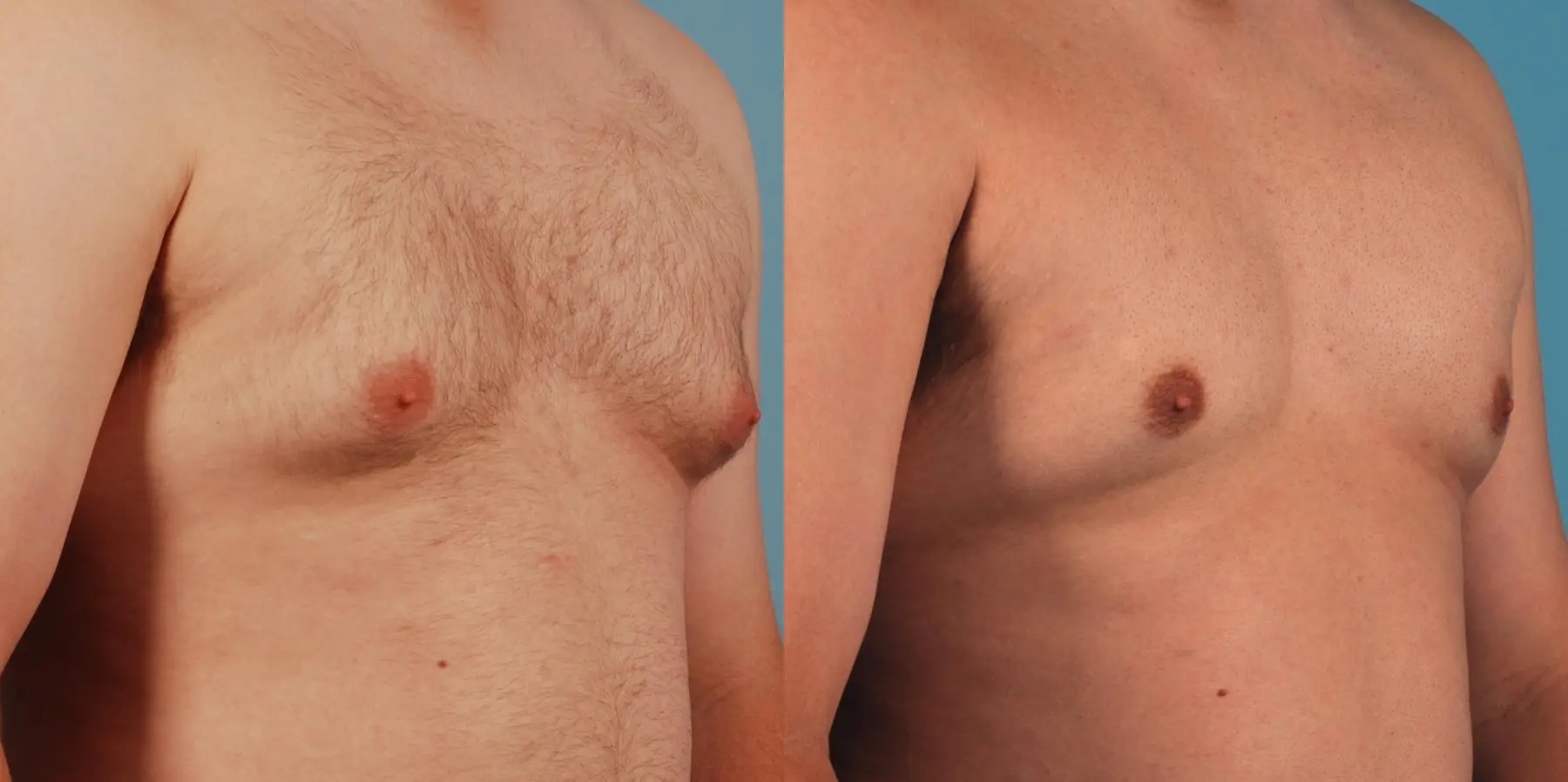 Liposuction For Men: Patient 3 - Before and After 3