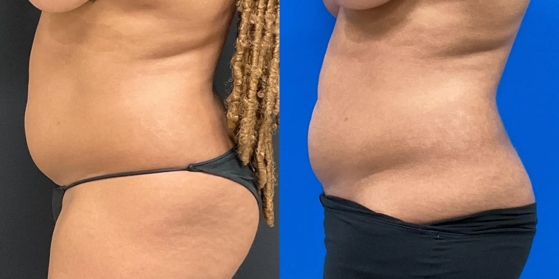 Liposuction: Patient 2 - Before and After 4