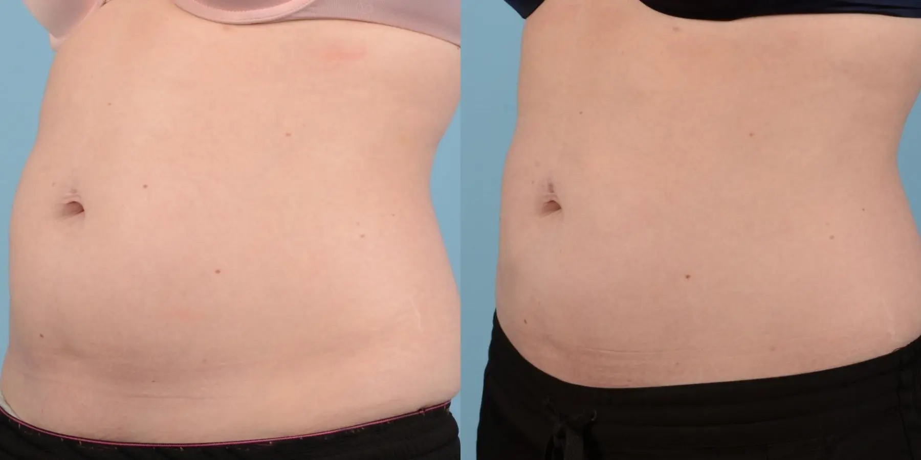 Liposuction: Patient 6 - Before and After 2