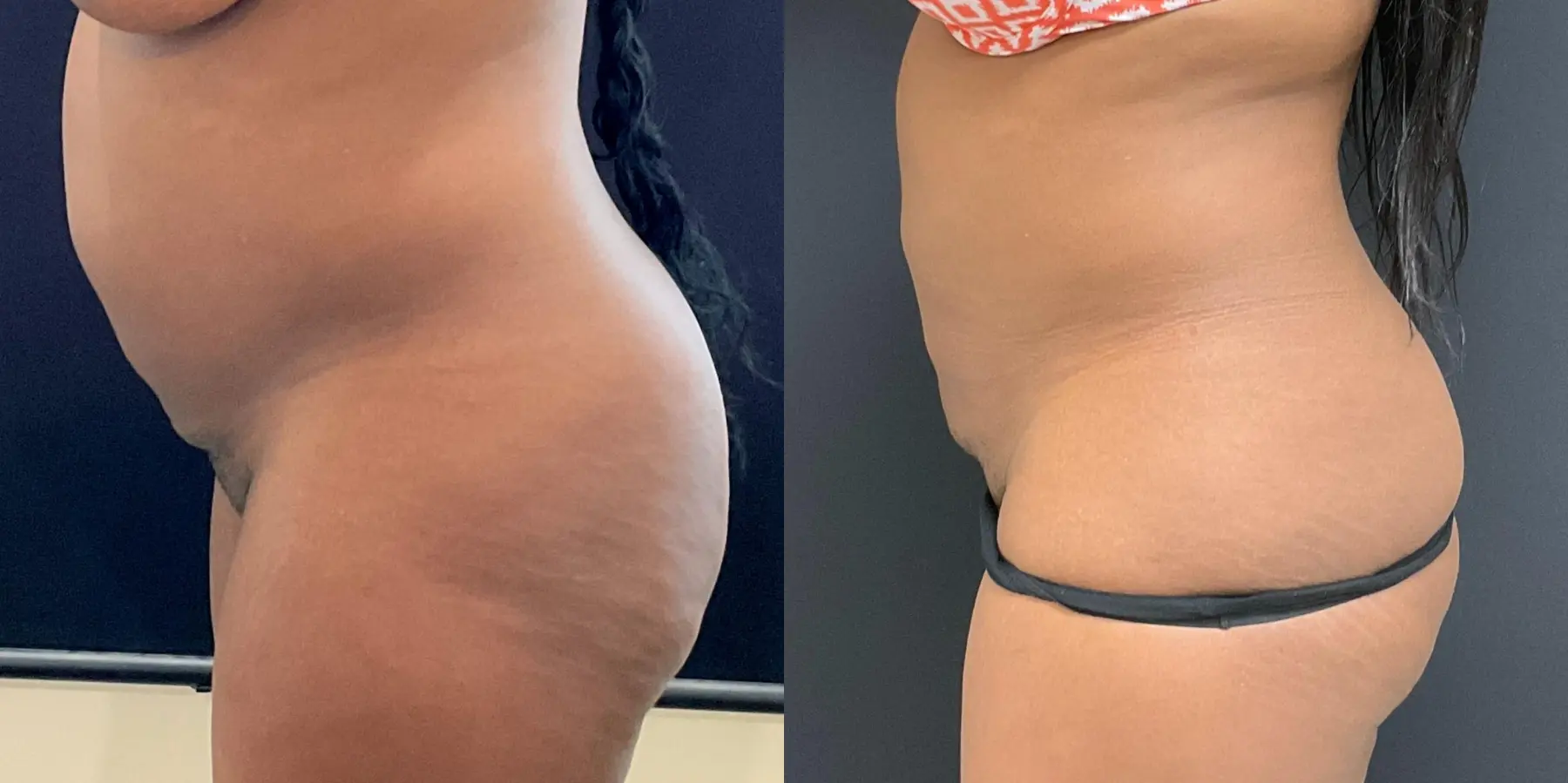 Liposuction: Patient 5 - Before and After 4